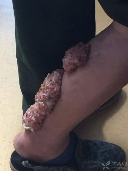 腿上出现“肉芽肿”,她说填了三个月没消