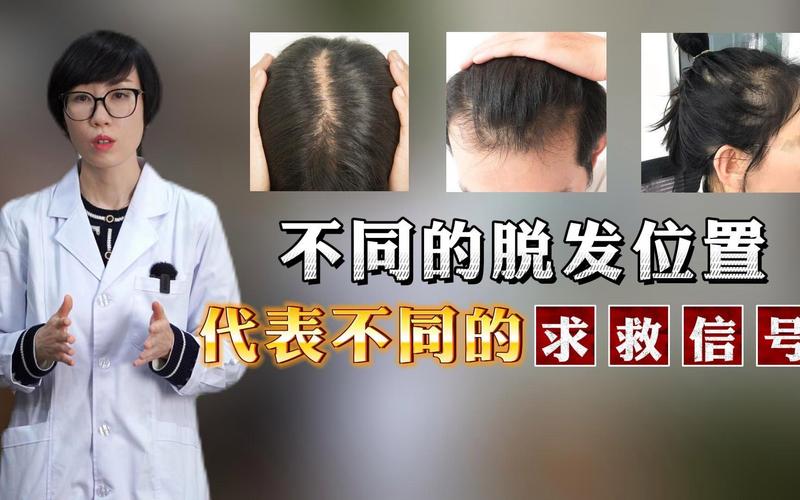 这样脱发可能是心脏在“呼救”!留意4个心脏的求救信号